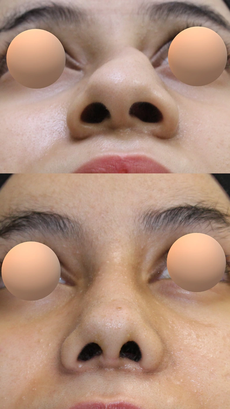 تجميل الأنف المنحرف — من الأسفل