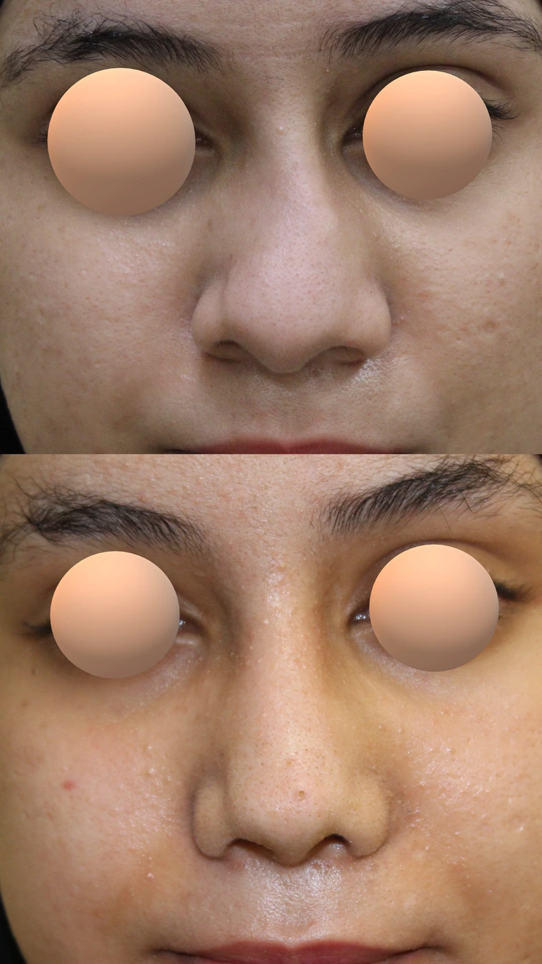 تجميل الأنف المنحرف — من الأمام