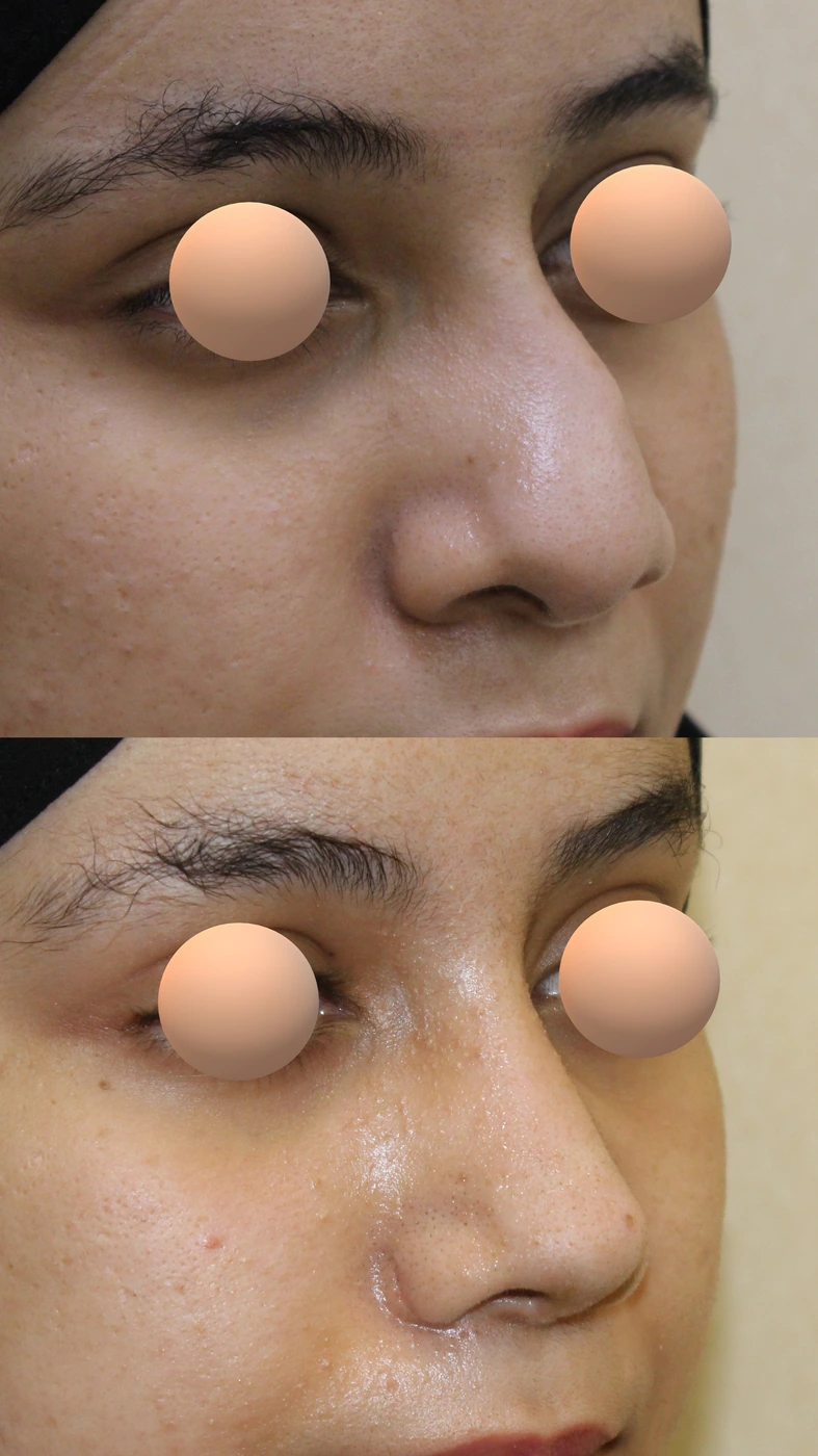 تجميل الأنف المنحرف — زاوية مائلة يمينًا