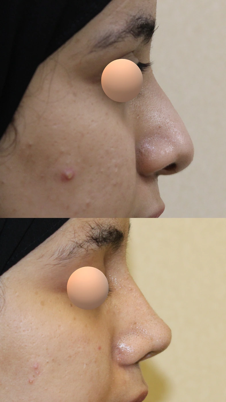 تجميل الأنف المنحرف — الجانب الأيمن