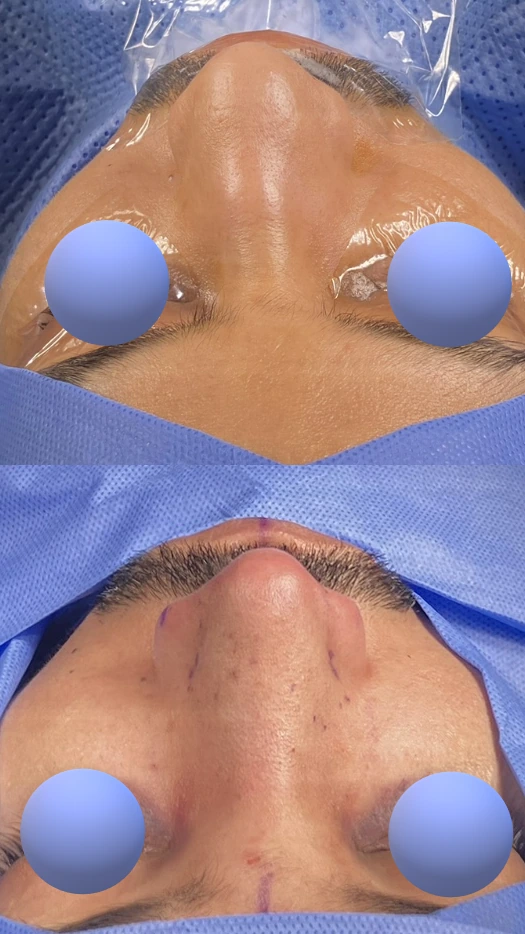 تجميل الأنف للرجال — من الأعلى