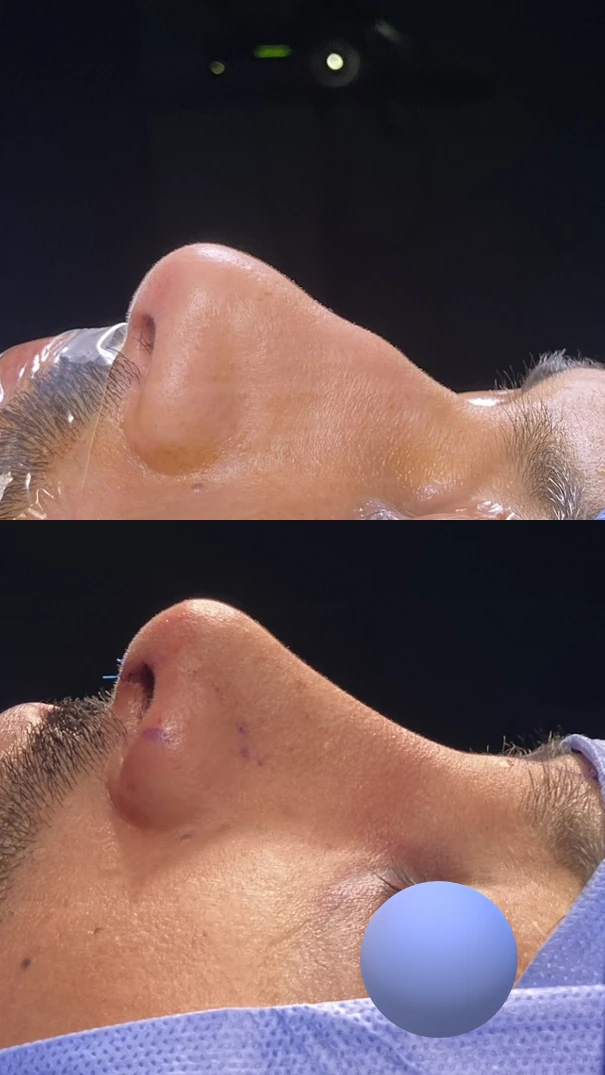 تجميل الأنف للرجال — الجانب الأيسر