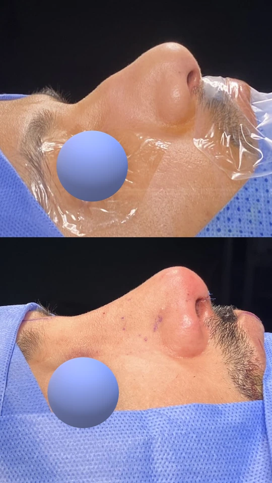 تجميل الأنف للرجال — الجانب الأيمن