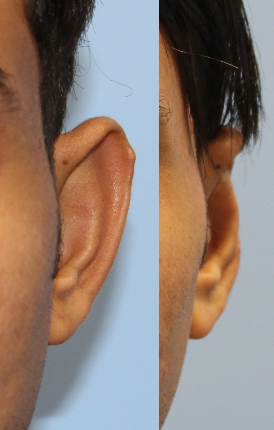 تجميل الأذن — الأذن اليسرى