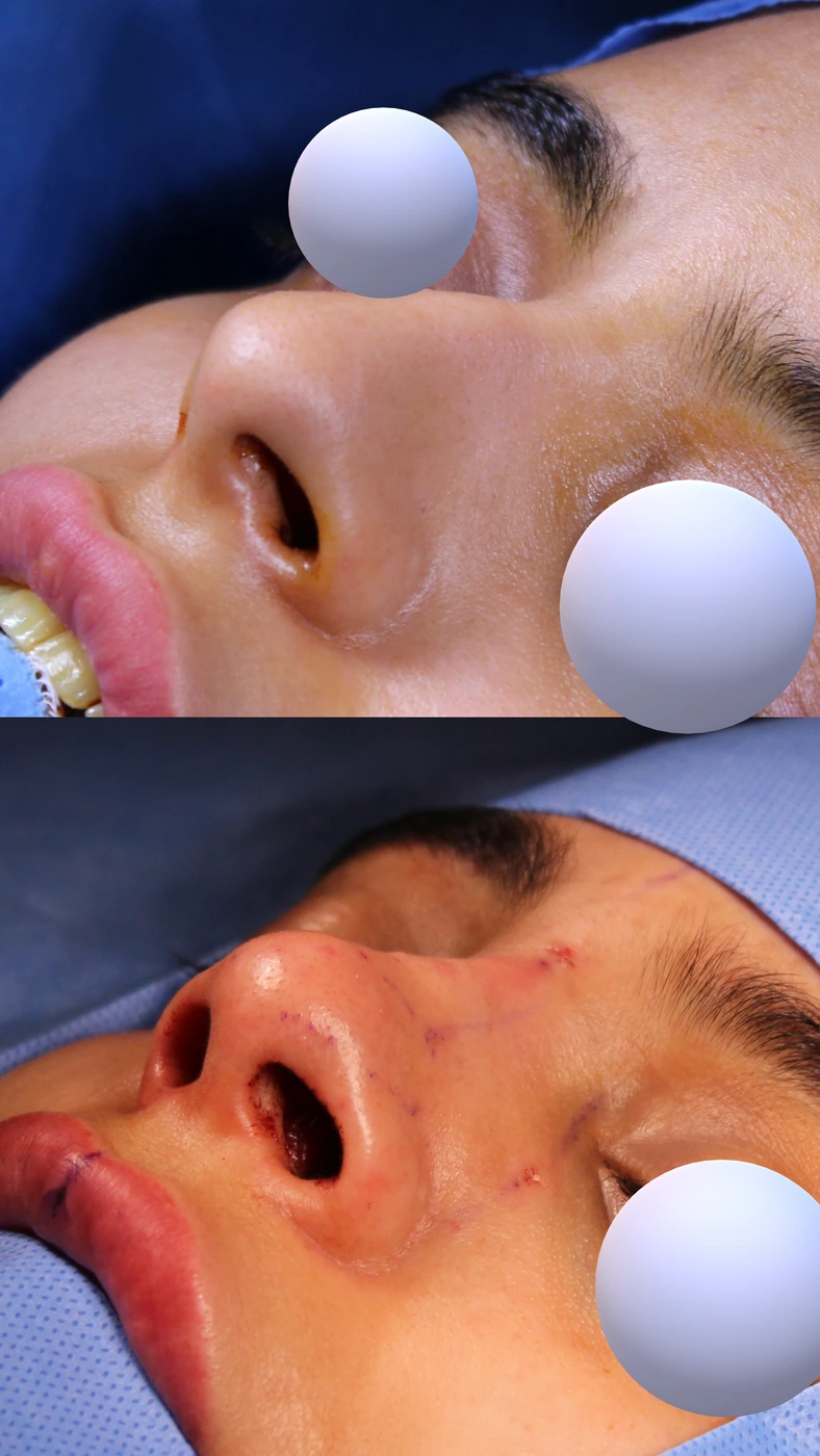 تجميل الأنف بالطريقة المغلقة والمحافظة — زاوية سفلية يسارًا