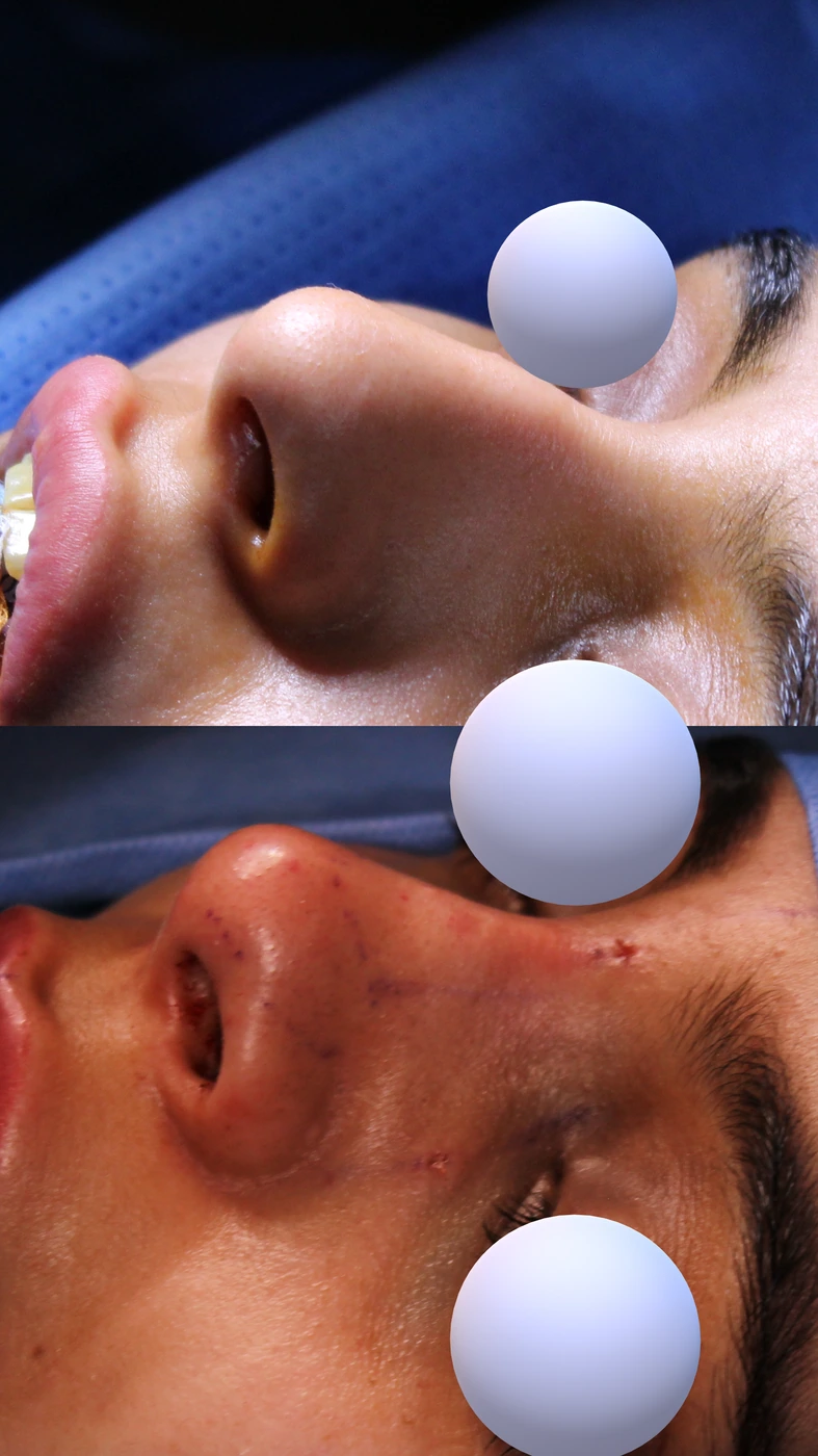 تجميل الأنف بالطريقة المغلقة والمحافظة — زاوية مائلة يسارًا