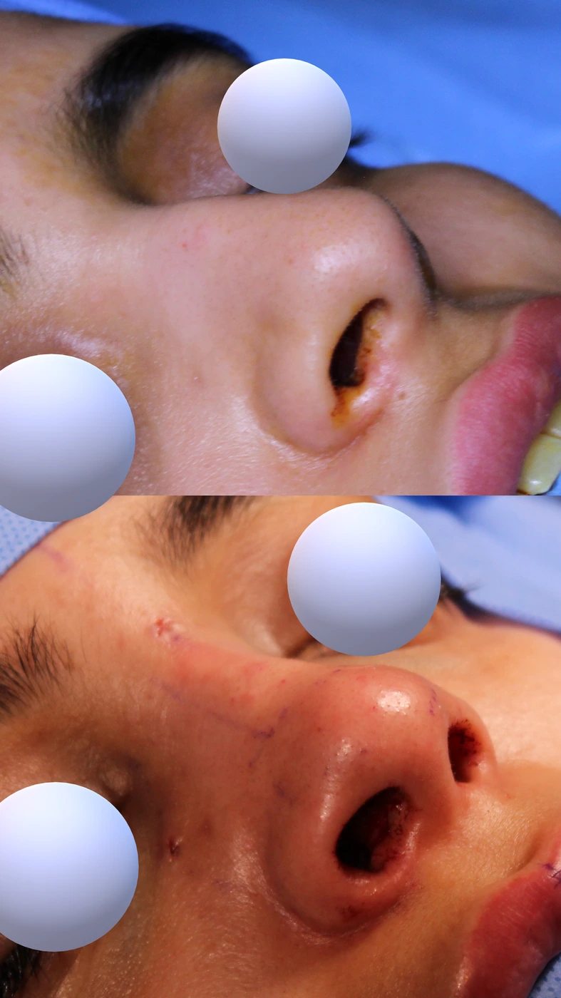 تجميل الأنف بالطريقة المغلقة والمحافظة — زاوية سفلية يمينًا