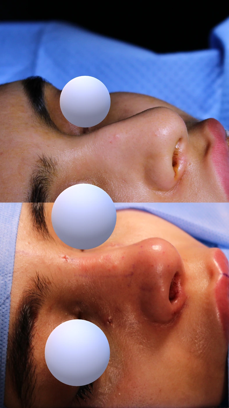 تجميل الأنف بالطريقة المغلقة والمحافظة — زاوية مائلة يمينًا