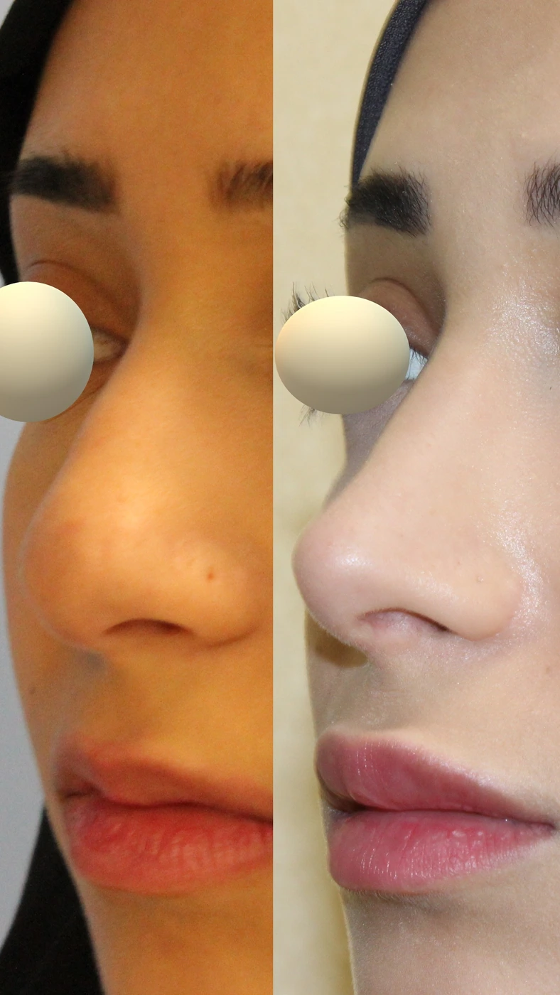 تجميل الأنف · الحالة الأولى — زاوية مائلة يسارًا