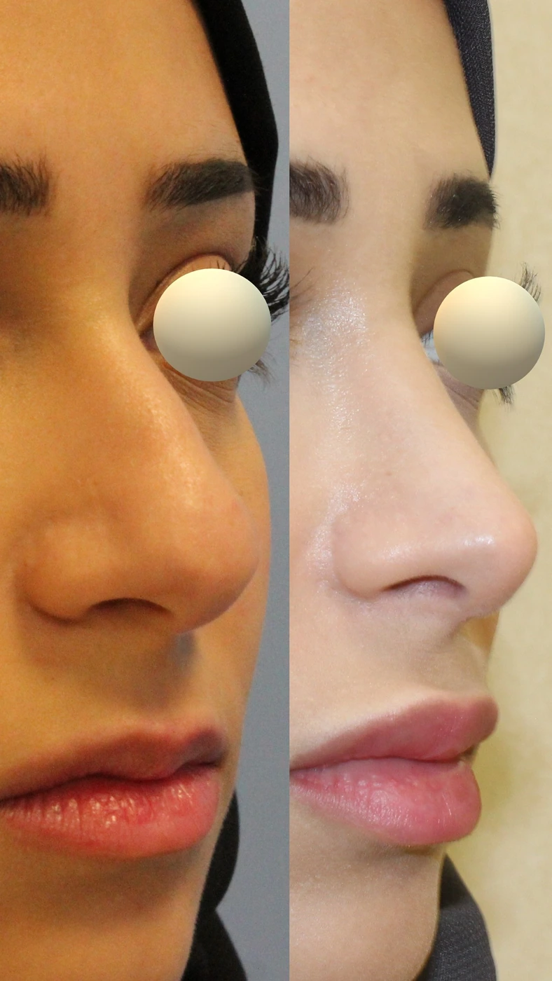 تجميل الأنف · الحالة الأولى — زاوية مائلة يمينًا