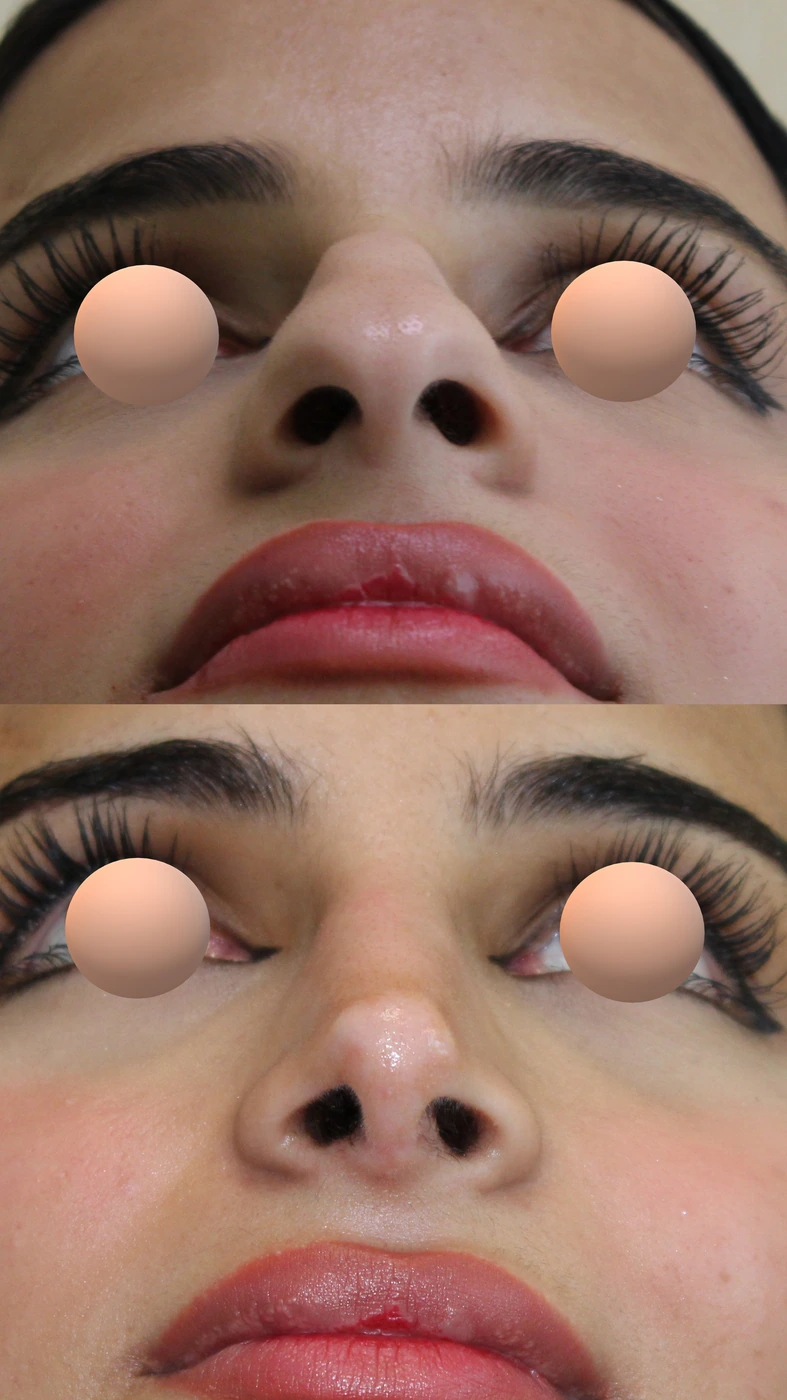 تجميل الأنف · الحالة الثانية — من الأسفل