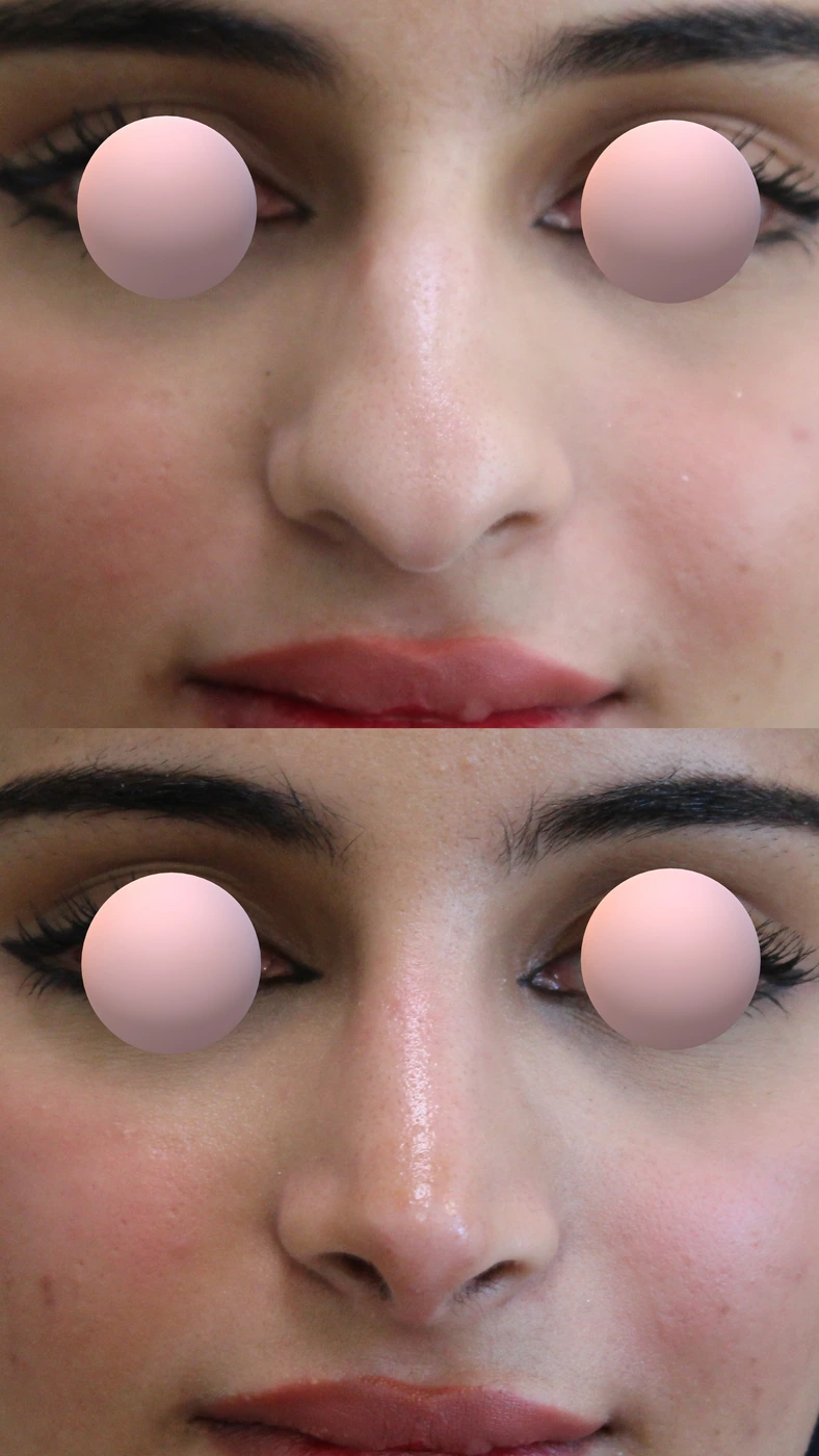تجميل الأنف · الحالة الثانية — من الأمام