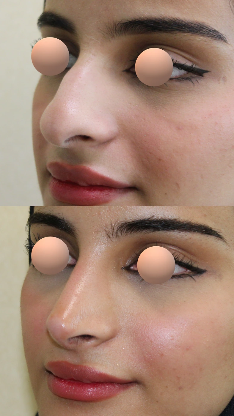 تجميل الأنف · الحالة الثانية — زاوية مائلة يسارًا