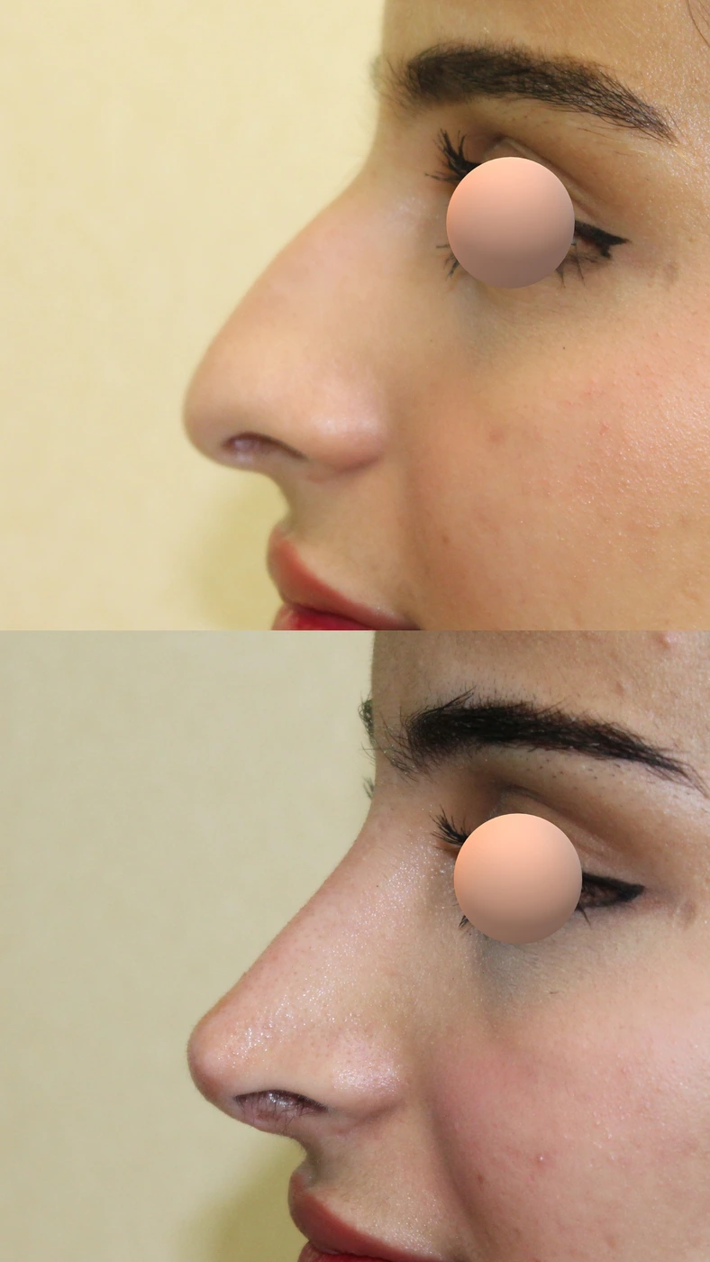 تجميل الأنف · الحالة الثانية — الجانب الأيسر