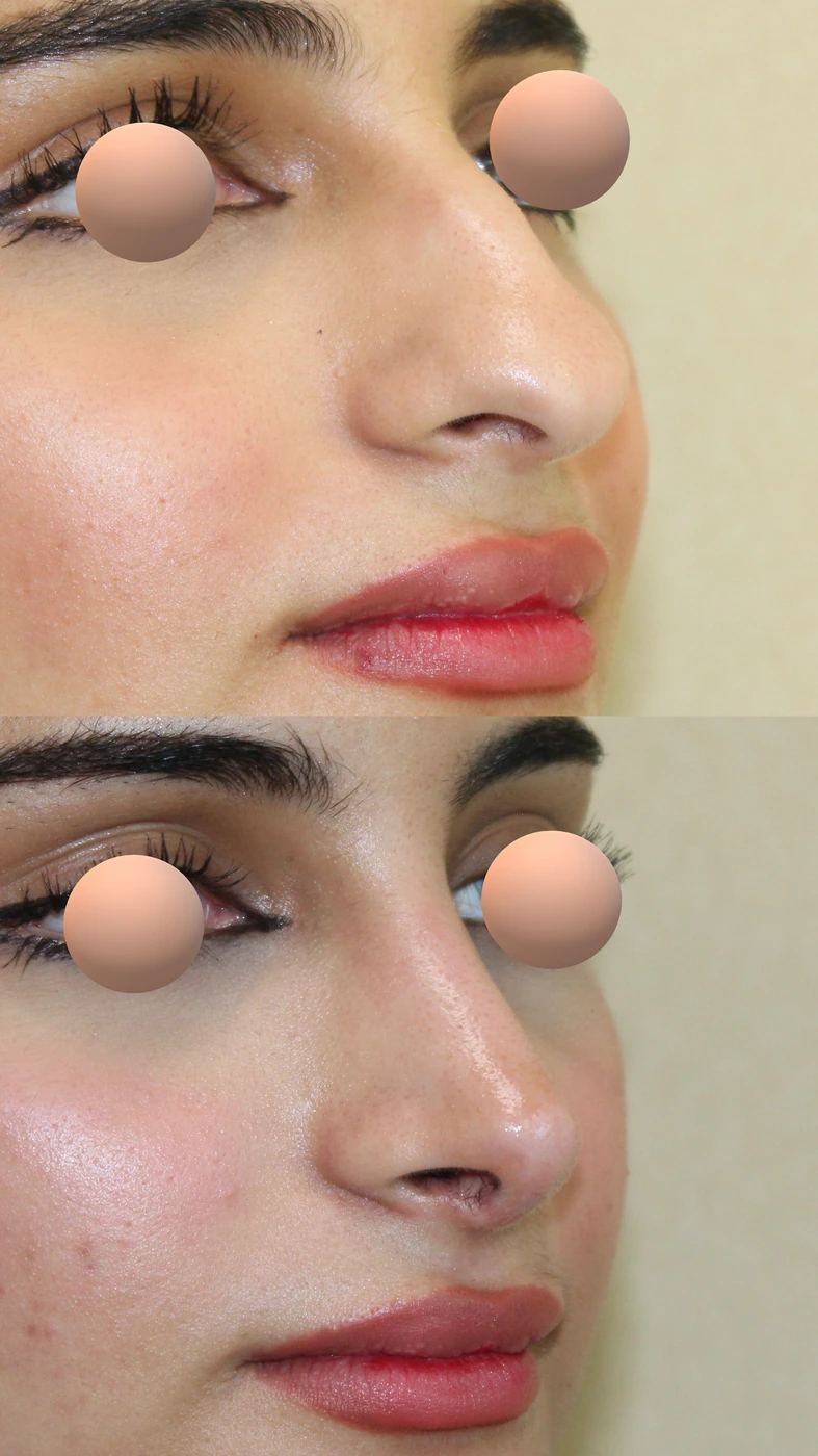 تجميل الأنف · الحالة الثانية — زاوية مائلة يمينًا