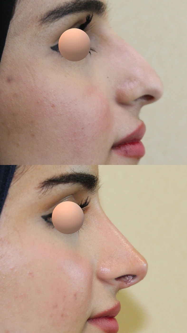 تجميل الأنف · الحالة الثانية — الجانب الأيمن