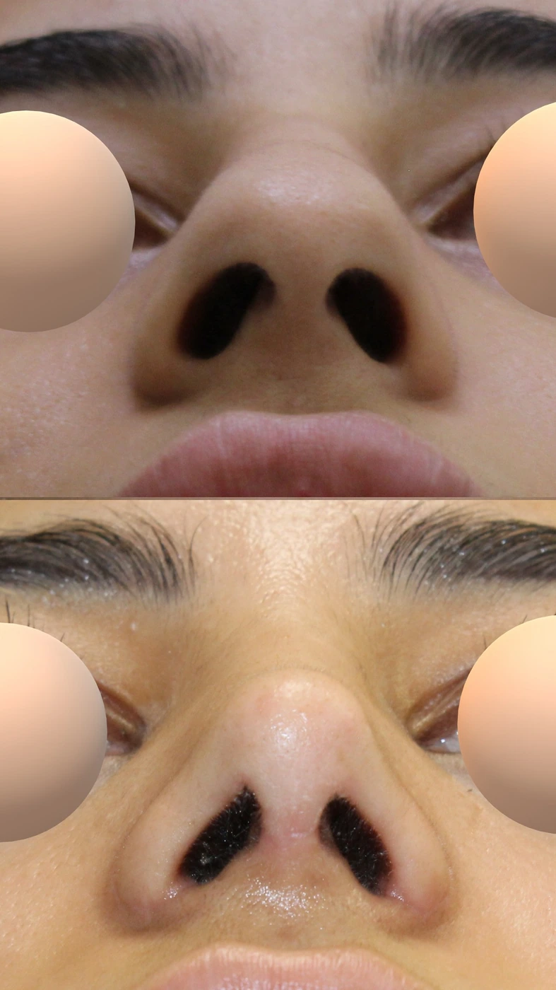 تجميل الأنف · الحالة الثالثة — من الأسفل