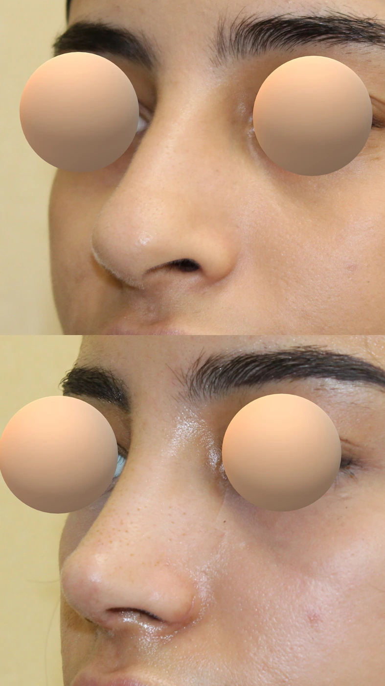 تجميل الأنف · الحالة الثالثة — زاوية مائلة يسارًا