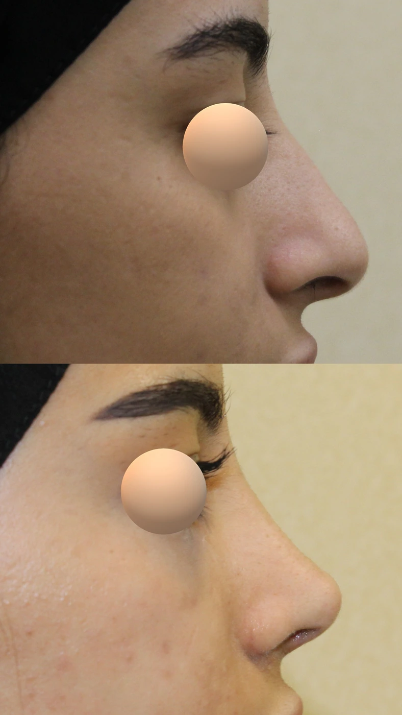 تجميل الأنف · الحالة الثالثة — الجانب الأيمن